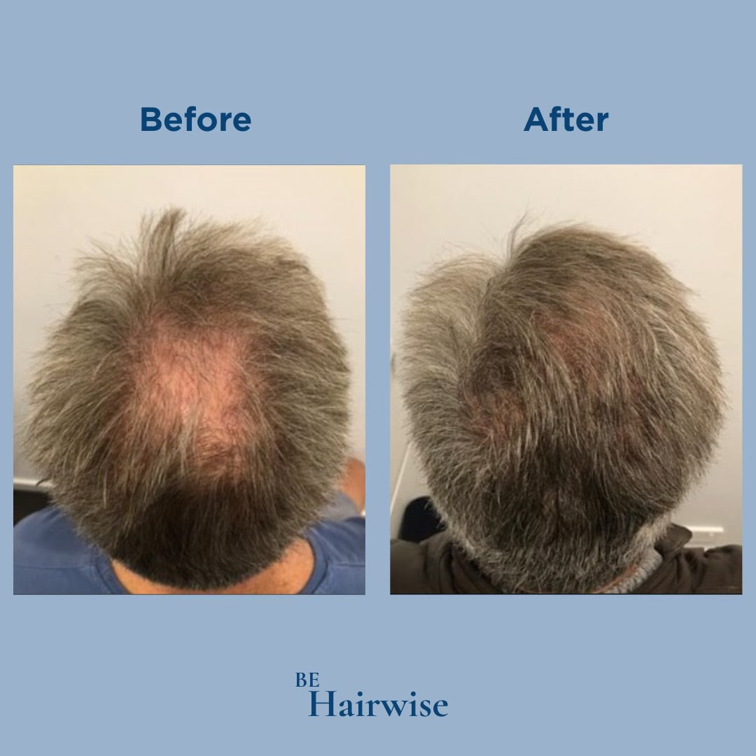 HairWise Advanced Hair Growth Roll-On Serum