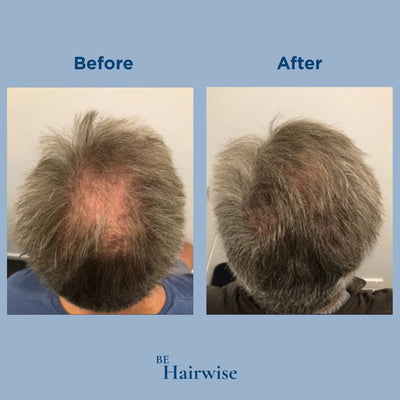 HairWise Advanced Hair Growth Roll-On Serum