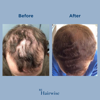 HairWise Advanced Hair Growth Roll-On Serum