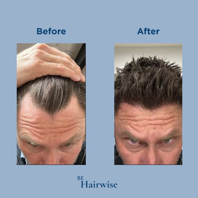 HairWise Advanced Hair Growth Roll-On Serum